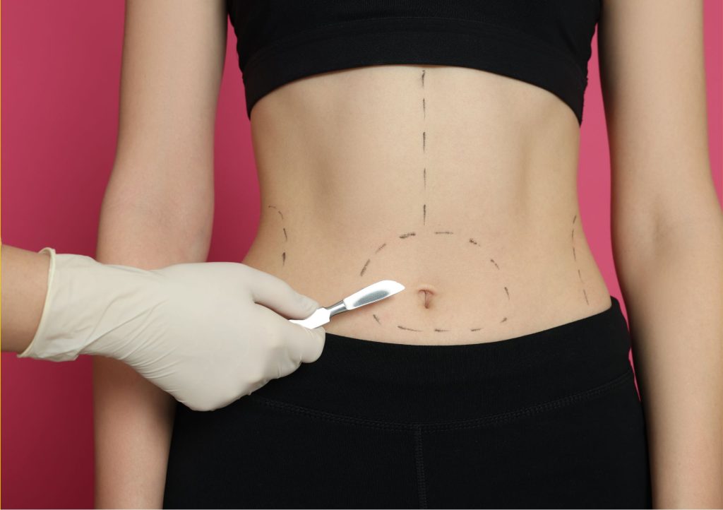 Zmniejszenie żołądka, to operacja bariatryczna ingerująca w układ trawienny.